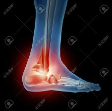 tendon d'achile